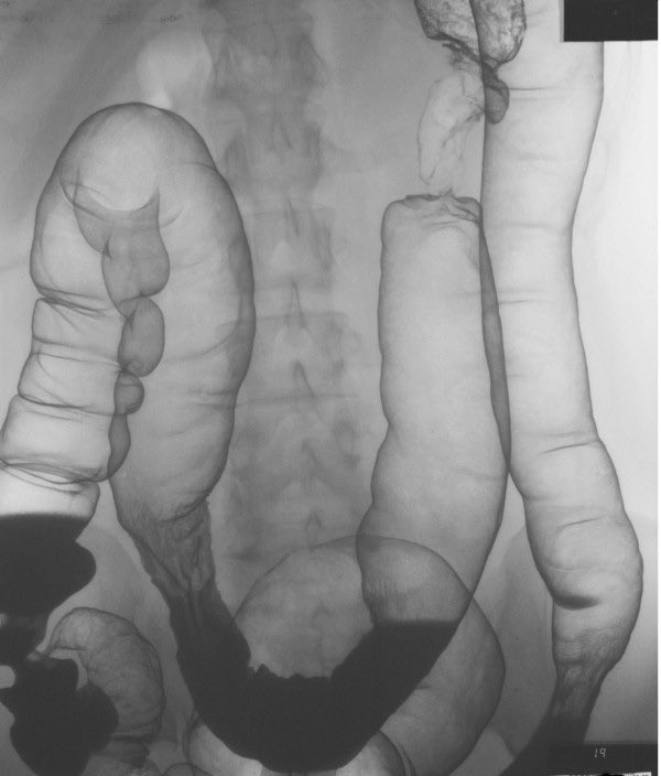 Found in a patient with diarrhoea. What is the abnormality here?