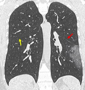 Which lobe of the lung has the pneumonia? Arrows highlighting fissures separating the lobes.

See the context for this image and more for free at amphonors.com #peermentor #anatomy #medschool #medstudent #premed