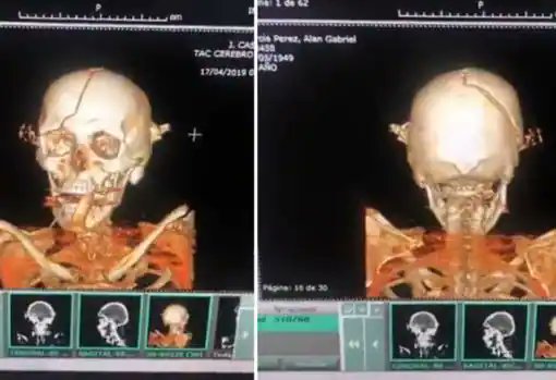 Hasta la derecha se cree el cuento de los caviares que Alan está vivo? Aquel día que se suicidó fueron los mismos zurdos que viralizaron una foto de Alan Garcia mu3rt0. Típico de estos amorales. Esta es la radiografia compartida por ABC internacional => shorturl.at/bfhT7