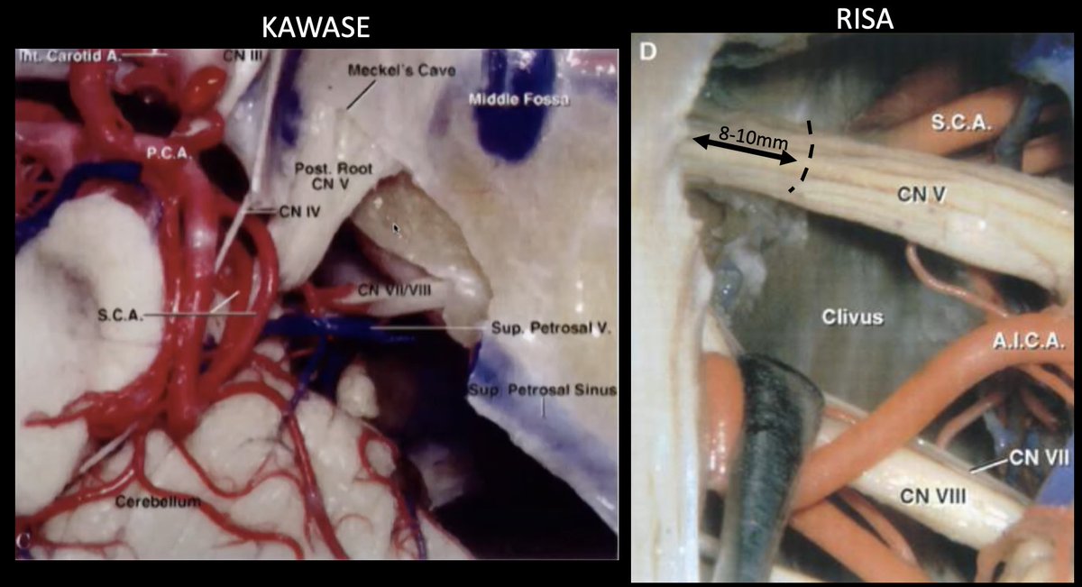 #MorcosChallenge The bone drilled in the Kawase from above and Kawase from below (RISA) are the same. The petrous apex is removed in both and in both approaches,you work between CN5 and 7/8 @EvaWuMD @UTHNeuro @nasbsorg @neurosurgatlas @neuronotes @medclinicalcase @e1v1m1 @nansig1