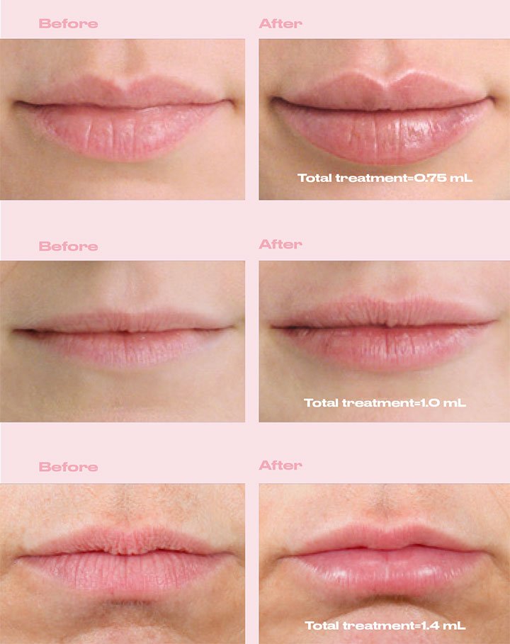 Restylane® Kysse is the only FDA-approved lip filler to use a new unique technology called XpresHAn, which allows for more natural lip movements and has more elasticity than other lip fillers out there. It also has a lip like feel which meshes imperceptibly with your own tissue!