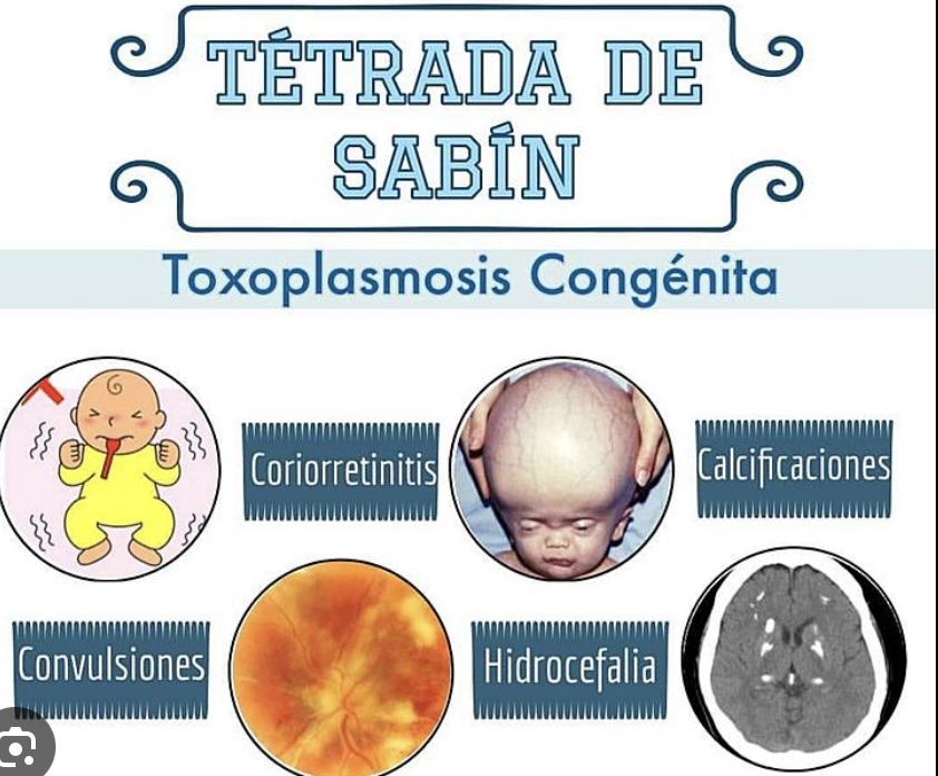 TOXOPLASMOSIS CONGENITA. 

Tetrada de Sabin '4c'.
🔸) Coriorretinitis 
🔸)hidroCefalia
🔸) Calcificaciones Periventriculares
🔸)Convulsiones