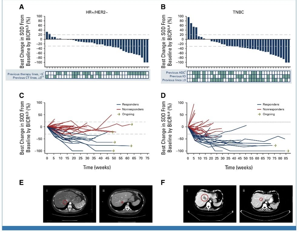 Datopotamab Deruxtecan in Advanced or Metastatic HR+/HER2– and TNBC:  TROPION-PanTumor01 Study 

🔍85 pts, heavily pretreated

HR+/HER2- and TNBC
ORR➡️27% and 32%
PFS➡️8.3 and 4.8 mo
OS➡️ NR and 13.5 mo

ILD➡️1 pts
No treatment-related deaths

@OncoAlert
 ascopubs.org/doi/10.1200/JC…