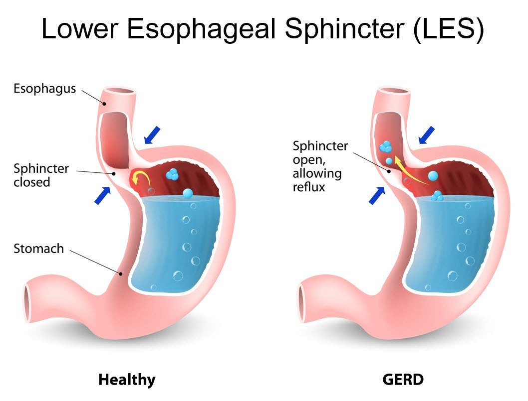 Low stomach acid is an epidemic:

• Acid reflux
• Abdominal pain
• Bloating
• Bacterial overgrowth
• Belching
• Maldigestion

All can happen as a result.

Driven by:

• Hypothyroidism
• Poor circadian regulation
• B vitamin deficiencies
• Low salt intake
• Stress
•…