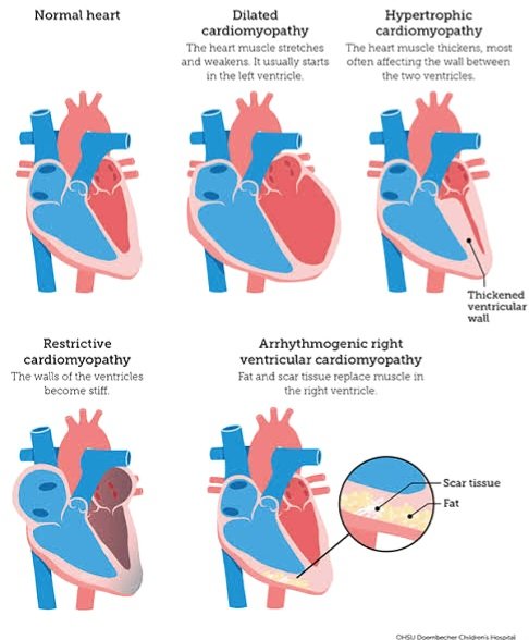 Cardiomyopathy in a Nutshell 🔬❤️ #cardiacpath