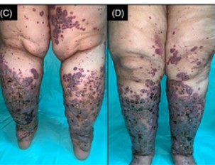 This case report was free to access 18 May 2022 util the publishers added a paywall.

Extensive cutaneous leukocytoclastic vasculitis after 
#Sinopharm vaccine, unfortunately the patient died.

 onlinelibrary.wiley.com/doi/10.1111/cu…