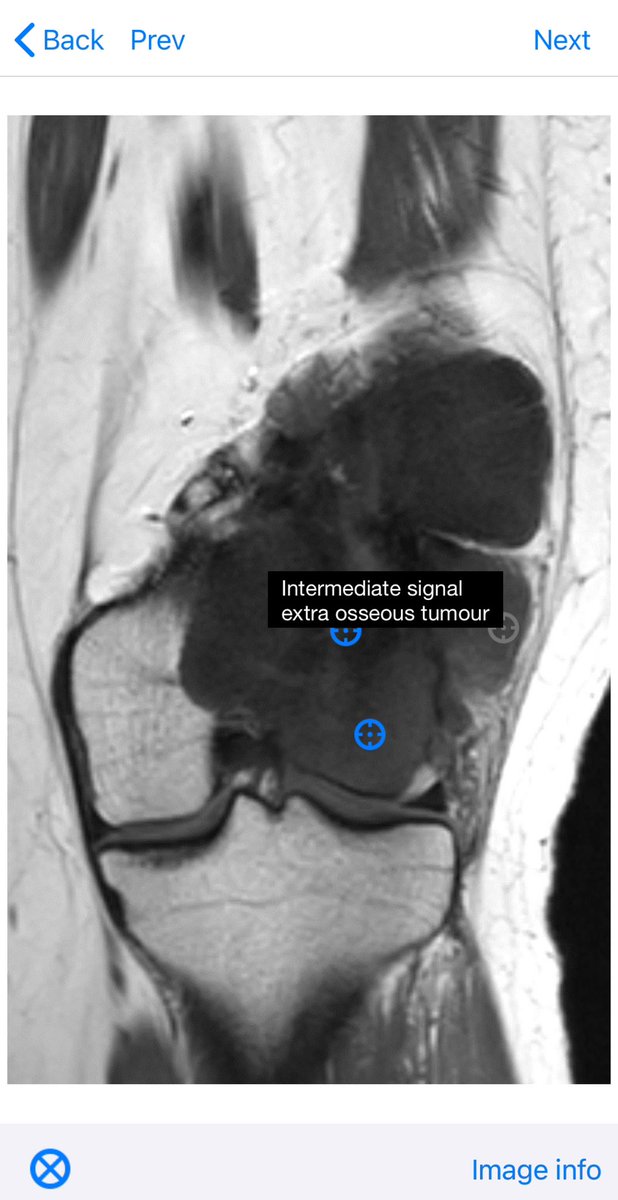 BoSTT_app's tweet photo. Case 118 in the app. Bone tumour on a 20 yo female.  #BSTpath #pathology #radiology #MSKrad #FOAMed #FOAMrad 
PS. Working on funds for android update. https://t.co/9s3XB3pruc