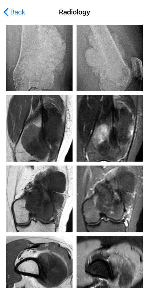 BoSTT_app's tweet photo. Case 118 in the app. Bone tumour on a 20 yo female.  #BSTpath #pathology #radiology #MSKrad #FOAMed #FOAMrad 
PS. Working on funds for android update. https://t.co/9s3XB3pruc