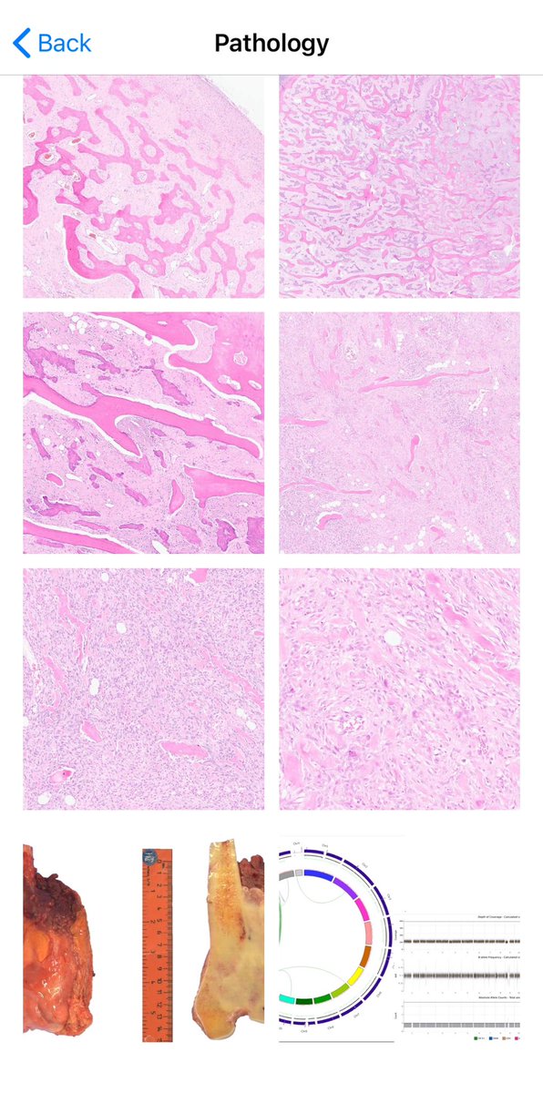 BoSTT_app's tweet photo. Case 118 in the app. Bone tumour on a 20 yo female.  #BSTpath #pathology #radiology #MSKrad #FOAMed #FOAMrad 
PS. Working on funds for android update. https://t.co/9s3XB3pruc
