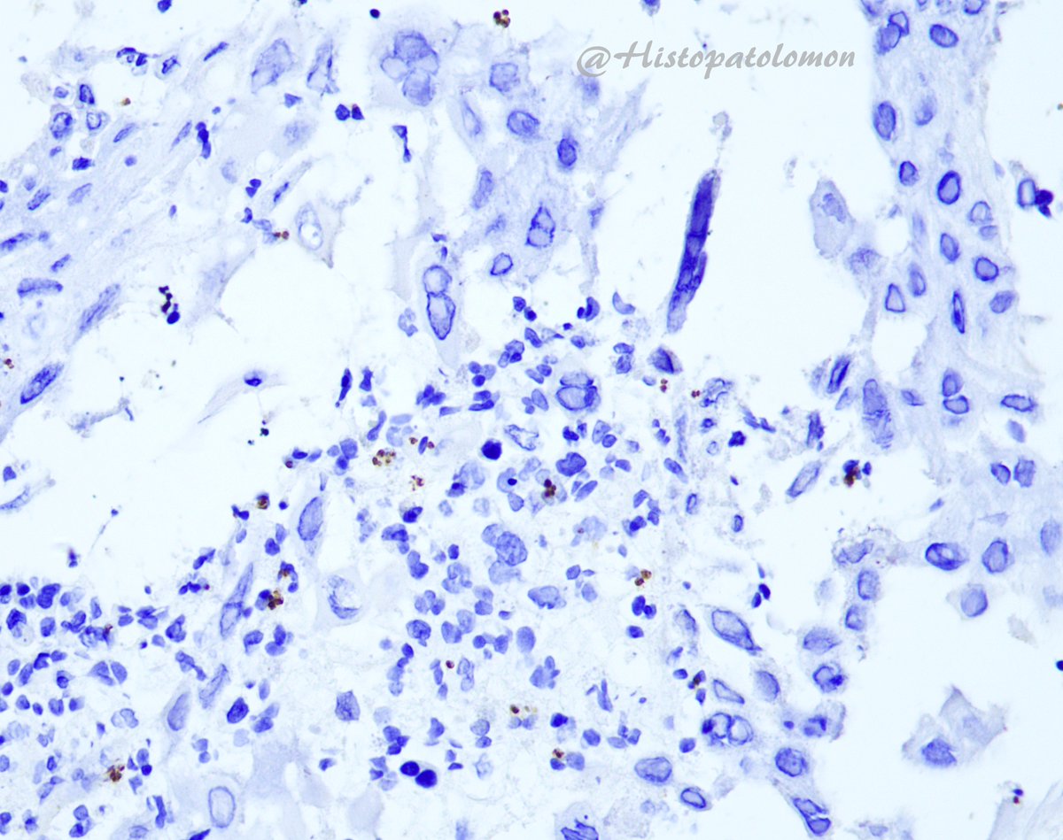 Histopatolomon's tweet photo. CD1a para Leishmania #Leishmania #CD1a #IHCpath https://t.co/ITcvgsMToG