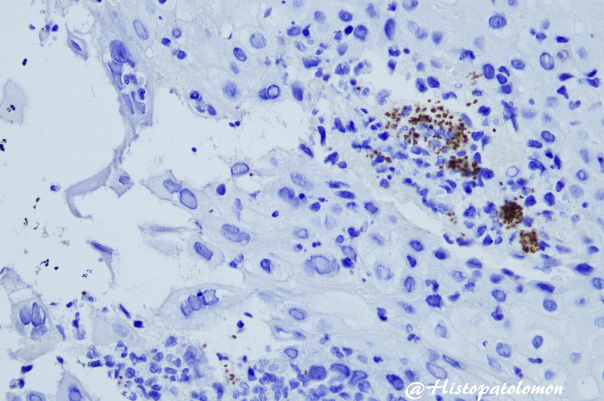 Histopatolomon's tweet photo. CD1a para Leishmania #Leishmania #CD1a #IHCpath https://t.co/ITcvgsMToG