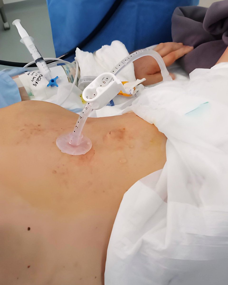 #Servicios | Nuestros profesionales garantizan una nutrición adecuada en pacientes con problemas de deglución, a través de la gastrostomía para colocación de sonda de alimentación vía endoscópica (GEP)
#ElNuevoEcuador