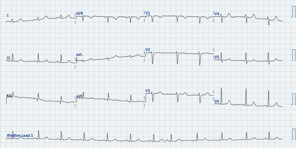 A case where a PAC triggers a short run of WAP 🤔 Middle-aged female with palpitations and chest tightness (but asymptomatic during ECG)