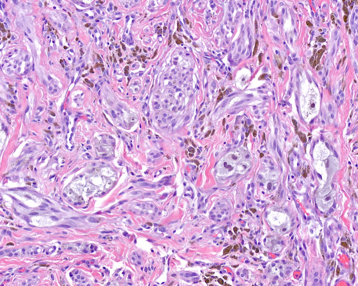 Fifth Dimension dermpath: Up-up and away in my beautiful balloon — my beautiful ALK-fused pigmented Spitz nevus with ballon cell change, that is…