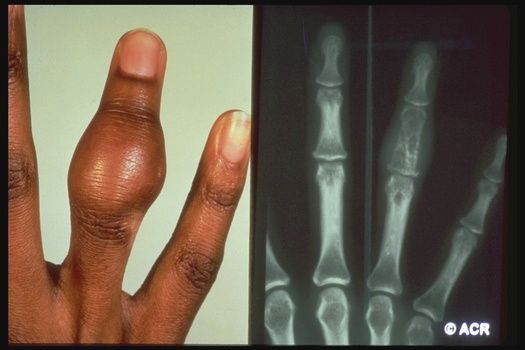 Articular Findings Sarcoidosis:
- Acute arthritis: Lg Jt Oligoarthritis; Loffgrens syndrome (hilar LN, arthritis, E. nodosum)
- Acute > Chronic arthritis
- Chronic arthritis: tenosynovitis, oligo- &polyarthritis, dactylitis, erosions or Jaccouds arthritis
buff.ly/3JNY9Lf