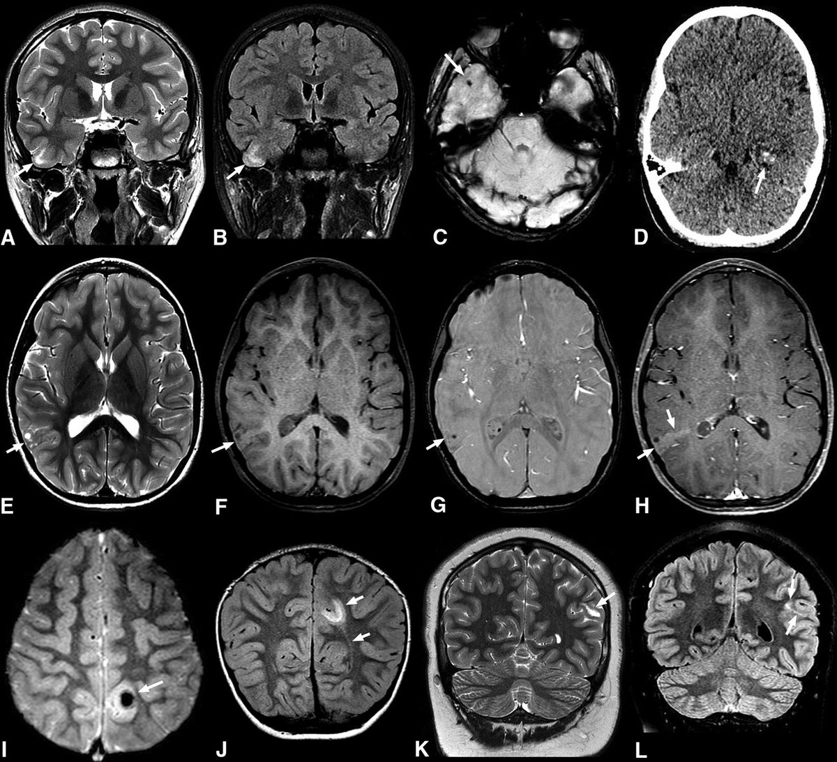 Expanding the Imaging Spectrum of Polymorphous Low-Grade Neuroepithelial Tumor of the Young in Children ajnr.org/content/early/… @CHOPRadiology @crcerron @Fab_Neuroradio @luisoctaviotg and Dr. Vossough @TheAJNR @theAJNR_EIC