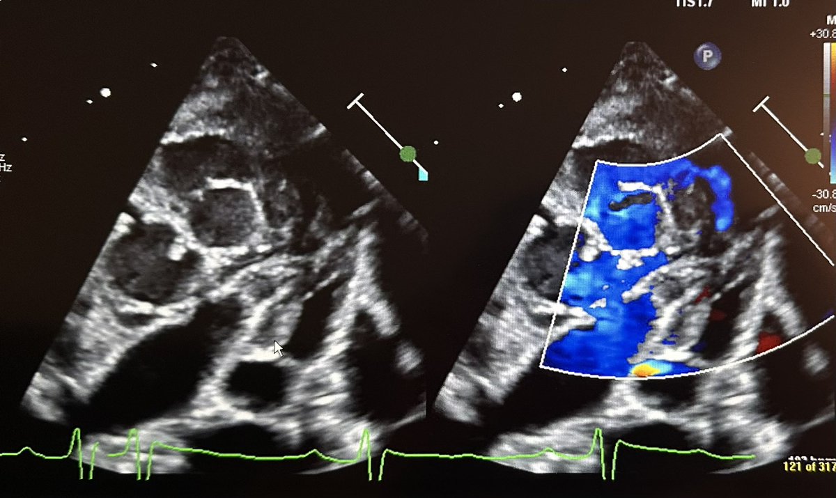 Once you see it, you can’t unsee it! Big and obvious left main in a hypertroph, surprised by the normal z score!
#coronaries #echofirst #pedscard
