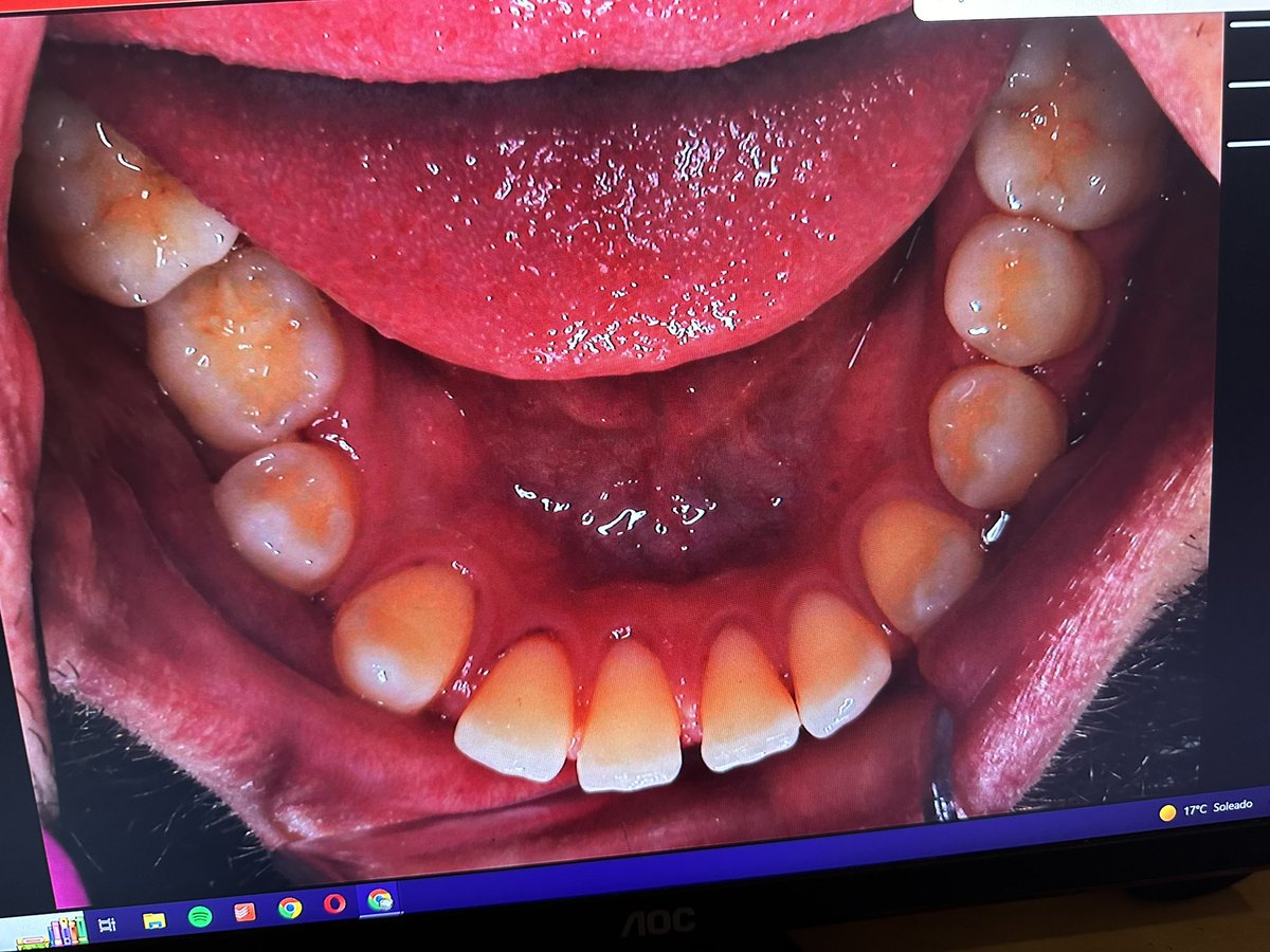 Mesioclusal's tweet photo. Paciente de 25 años con esta rx y oclusión https://t.co/3YW7DAszDP
