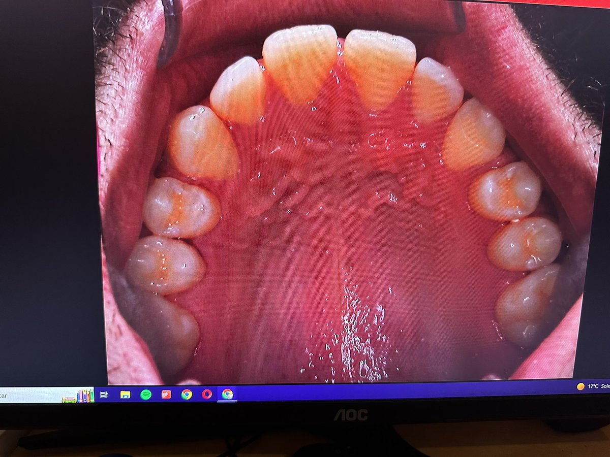 Mesioclusal's tweet photo. Paciente de 25 años con esta rx y oclusión https://t.co/3YW7DAszDP
