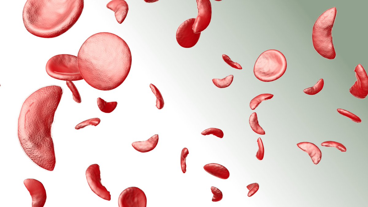 In @BloodAdvances, Dr. Saraf of @UICDom et al report phase I results of oral etavopivat in patients with sickle cell disease. See the data here: docwirenews.com/post/oral-etav… #SCD #MedTwitter