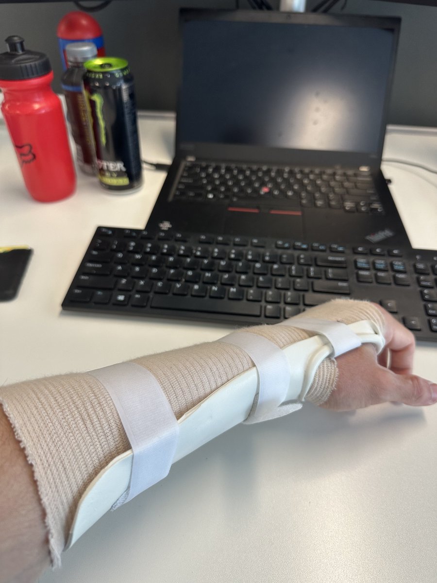 Wrist is feeling ok. Won’t be 100% for a good few months as I tore a few ligaments and tendons off the bone when I fractured it 😢
#fracture #fracturedwrist #rehab #rehabilitation #injury #mtb #mtblife #enduro #endurolife #sendit #DOWORKSON 
@100club100