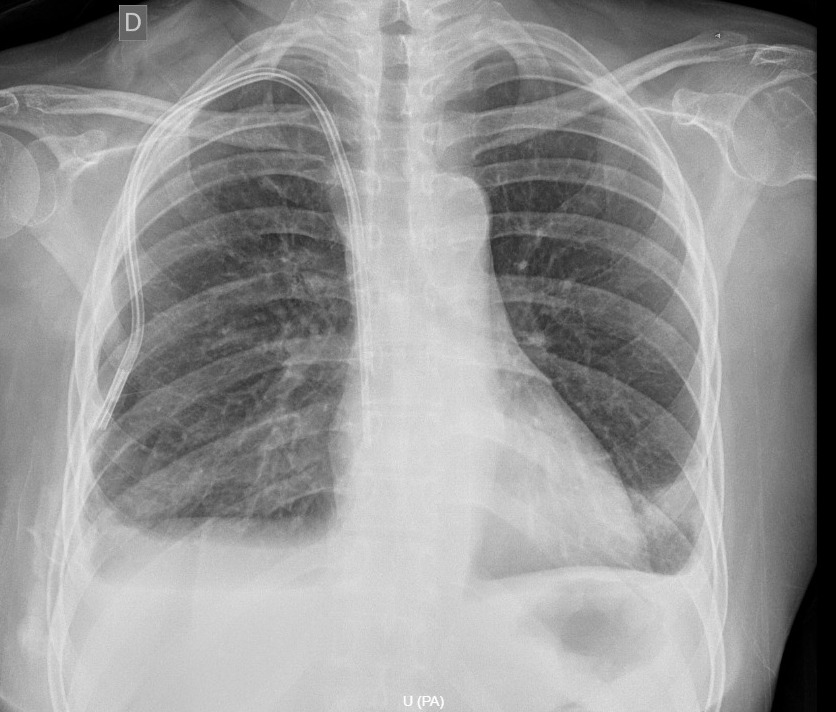 Día de CAF tunelizados 💪 #InterventionalNephrology #ISN #PocusPerucho #Slanh #Nefrología #Pocus #Hemodialisis