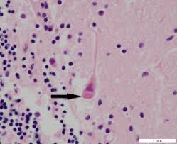 Negri bodies are nerve cell inclusions found in: A. Rabies infection B. Shigella