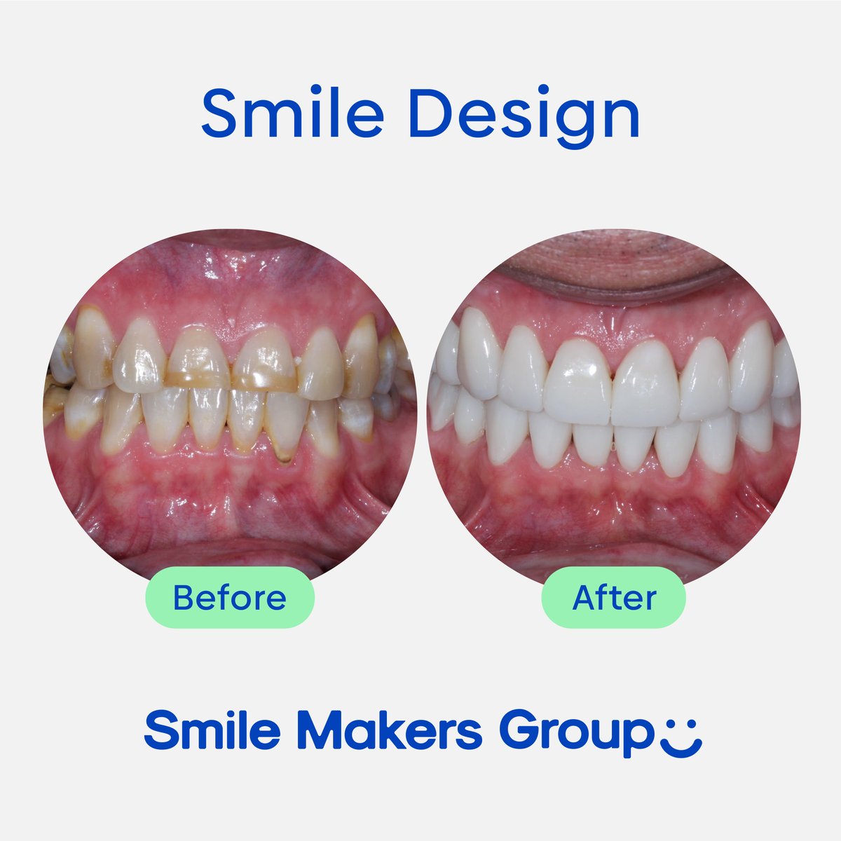 Our expert team crafts radiant smiles that inspire confidence. Ready to reveal your own stunning transformation? 😁🌟
🦷 Learn more at smilemakersgroup.io

#SmileDesign #BeforeAndAfter #ConfidentSmiles»