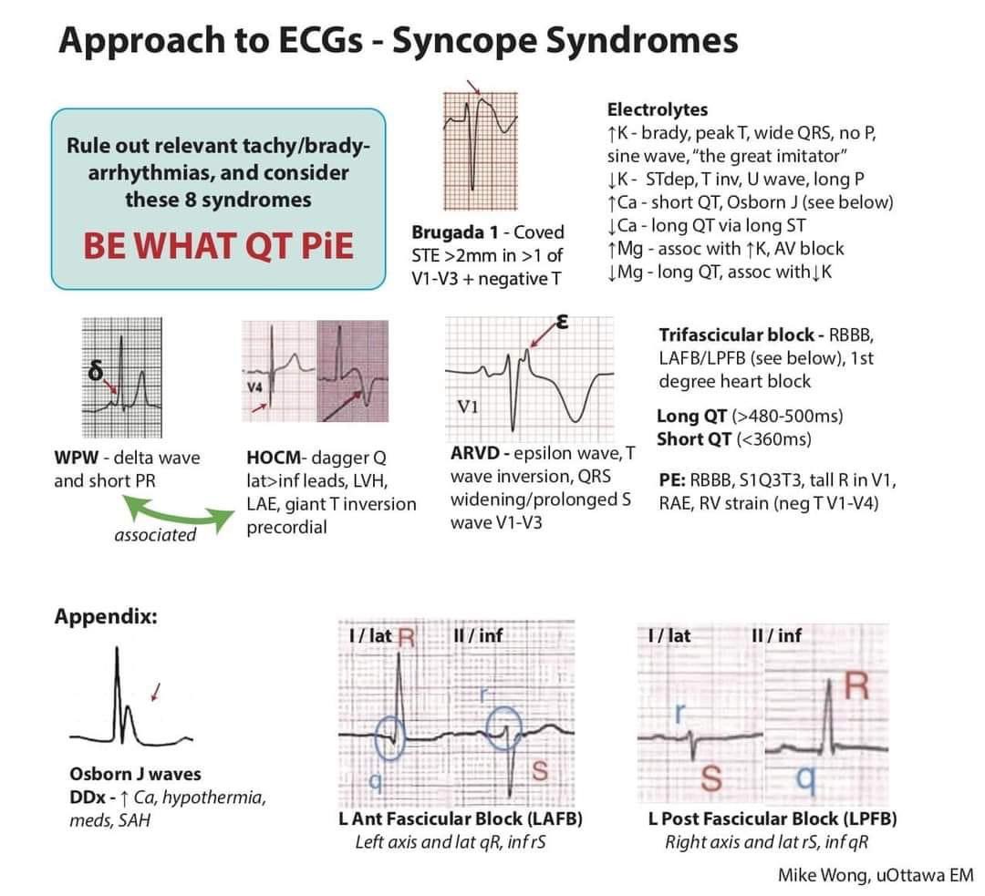 #Syncope #ECG BeWhatQtPie