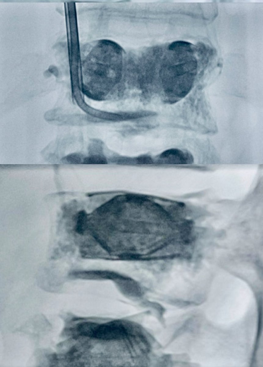 Every fracture clefts require thorough filling for effective pain relief. #SpineJack partially opened, necessitating trilateral access with curved needle to complete the filling of remaining cleft. Ensuring comprehensive fracture stabilization is crucial for adequate pain relief