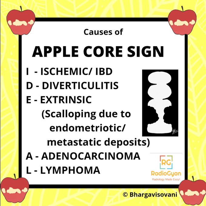 @drkeithsiau 'Apple core sign' - transverse colon ➡️ suspected adenocarcinoma

<Image source: @TeamRadioGyan, tinyurl.com/2bey9fah>