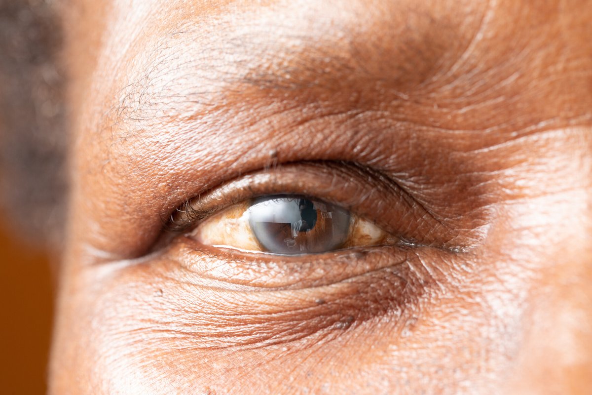 True or False: Cataracts always cause people to lose their vision. While cataracts can cause vision loss, treating the condition early can preserve your sight and prevent the cataracts from becoming worse. #visioncare #eyecare