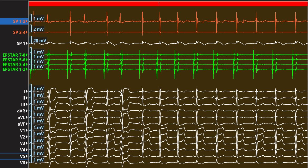 HaiderTaii's tweet photo. LV summit PVC. We started with mapping using EP Star to bracket the earliest spot. Then, using a Stable Point RF catheter and ICE guidance, we approached the endocardial side by choosing the closest anatomical point. Suppression was achieved with the first RF lesion! https://t.co/Jdt8Q6HA35