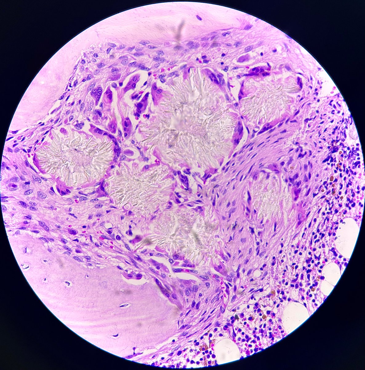 32 years old male with recurrent pelvic calculi, history of left nephrectomy planned for renal transplant. Referred from urology for unexplained cytopenias. How does bone marrow biopsy add to his story? 

#hemepath #hematology #pathtwitter #pathx

My first as a sign out :)