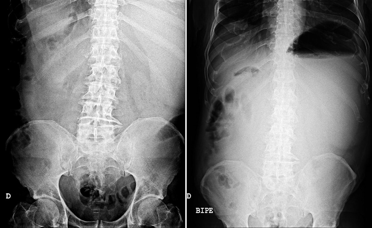 sapdes's tweet photo. 👴🏼89 años, refiere dolor abdominal 😫 de varios meses y vómitos 🤮
EF: MEG, abdomen timpánico. Presenta cicatriz de laparotomía 🔪.
💉: Hb 6.5 INR 2.47
Rx 🩻:
#casoSAPD https://t.co/yfYNWZhi2B
