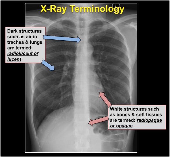 #Radiology  Chest x-ray terms for #medstudent #medstudenttwitter 🩻🧑‍🎓
