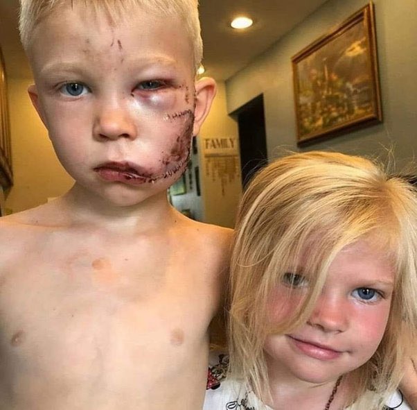 The face of courage , for me, is called Bridger , and it is the name of the child hero in the photo, who saved his younger sister who was only 6 years old by placing himself between her and a ferocious large dog that intended to bite her. Open the thread below for full story 👇