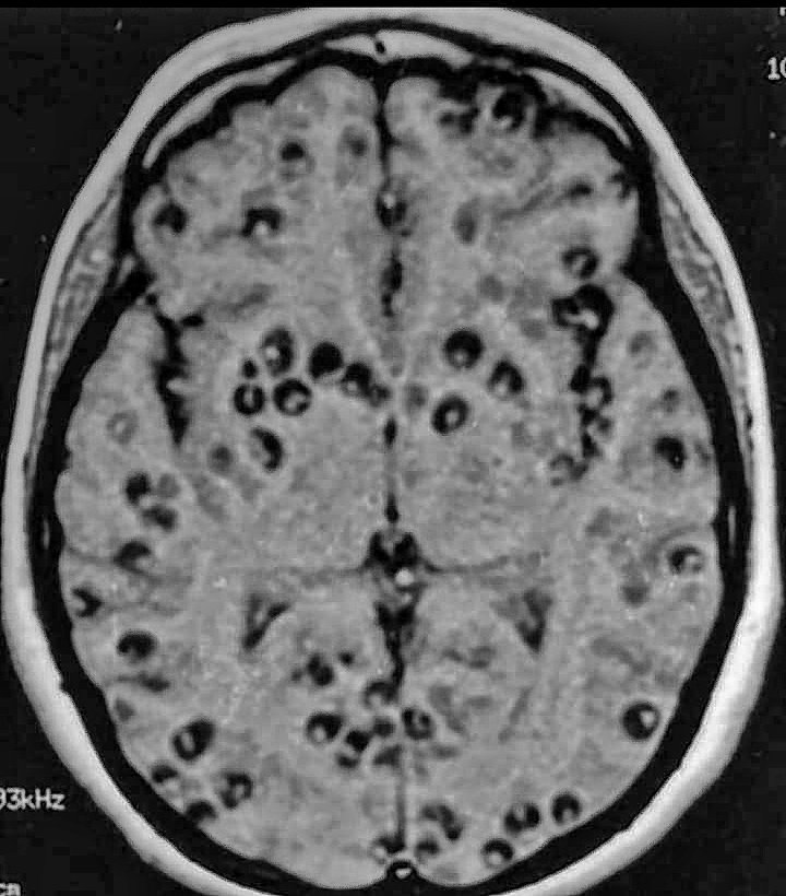 🩺𝘾𝙇𝙄𝙉𝙄𝘾𝘼𝙇 𝙎𝘾𝙀𝙉𝙀𝙍𝙄𝙊:-

A patient from latin America p/w acute hx of fits,severe headache & cognitive decline.He gave h/o of eating meal from restaurant few weeks back.

#Diagnosis ❓❓

Which #parasite is culprit ❓

#medx