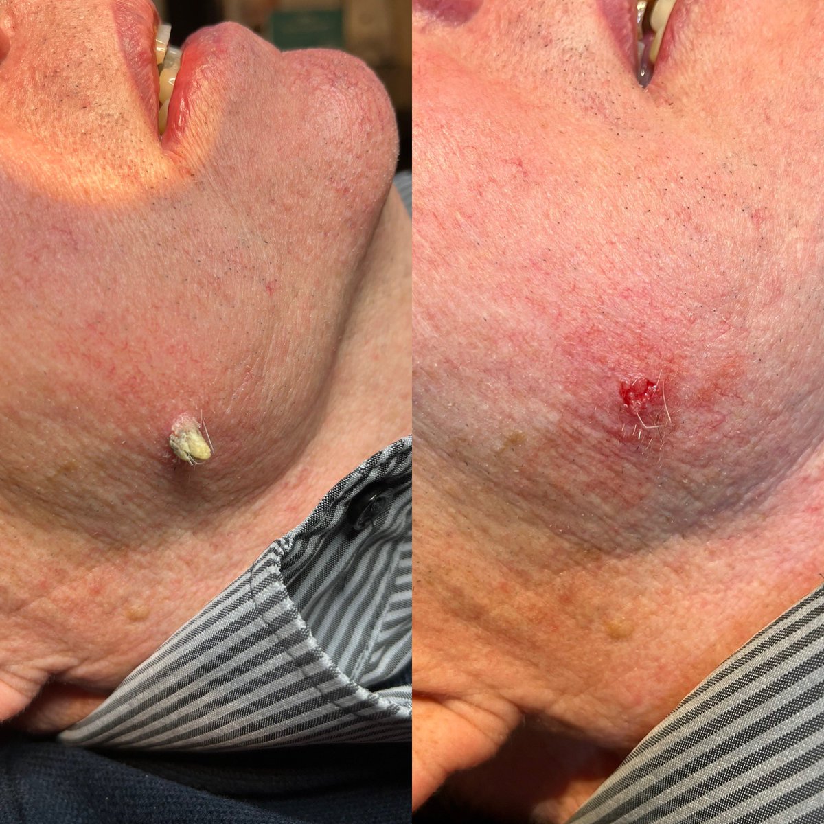 Removed this successfully. 
Got any skin lesions you would like removed?
#advancedskincare
#halcyondaysskincare
#advancedelectrolysis