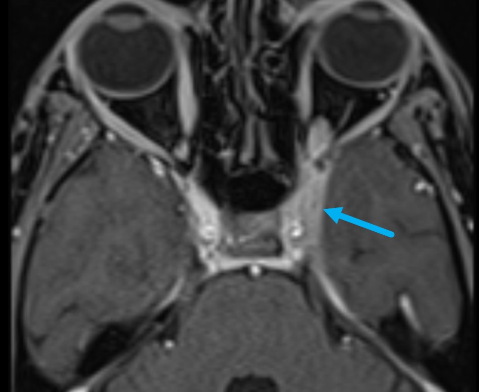 samrad77's tweet photo. Cavernous sinus thrombosis on imaging:

Direct signs

1. Loss of concavity with lateral bulging (i.e., convexity)—best seen on coronal CECT/CE-MRI (image 1)
2. Heterogeneous filling defects within the
cavernous sinus (image 1)

Indirect signs (when you see this, look for cavernous sinus carefully)

1. Thickened dural enhancement along the cavernous sinus margins (image 2)
2. Orbital apex inflammation (image 3)
3. Exophthalmos (image 3)