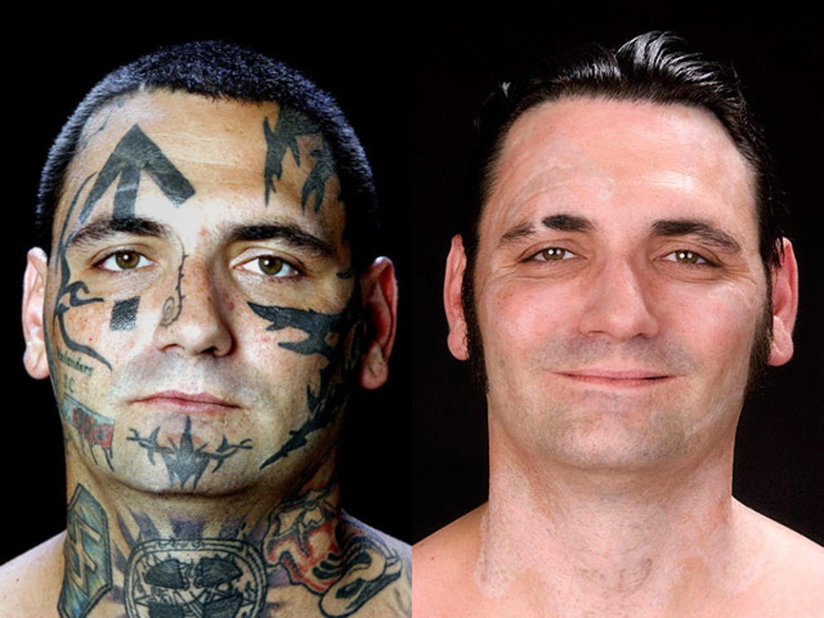 What hurts more than getting a tattoo? Removing one. Imagine removing not just one or two - but your entire face. That's what reformed Nazi Bryon Widner did, deciding the pain of living with marks of hatred on his face was worse than the agony it would take to remove them.