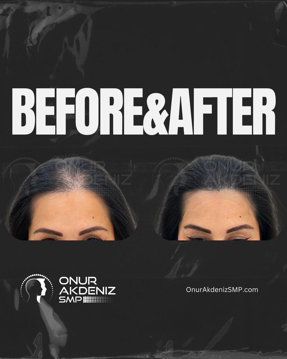 onurakdenizsmp's tweet photo. Enhance your natural radiance with precision and care, and discover the beauty of subtle transformation
#womensscalpmicropigmentation #phiscalp #scalpmicropigmentation #sclapmicropigmentationturkey #scalpmicropigmentationistanbul #micropigmentation #smp #OnurAkdeniz https://t.co/6YinCueIuX