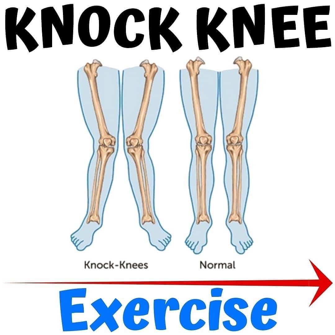 Artofphysique_'s tweet photo. Want to get rid of a knock knee?

Do this exercises 👇👇👇 https://t.co/0sIkBPS2HH