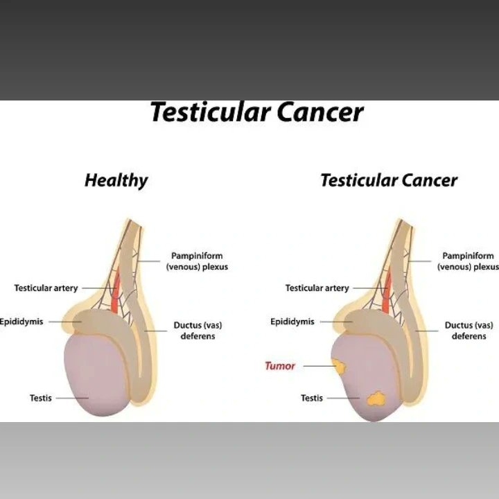 Testicular cancer doesn't discriminate—it can affect anyone, regardless of age or background. Let's raise awareness and support those affected by this disease.' 💙 #testicularcancerawareness #cancersucks #cancerawareness #nairobikenya