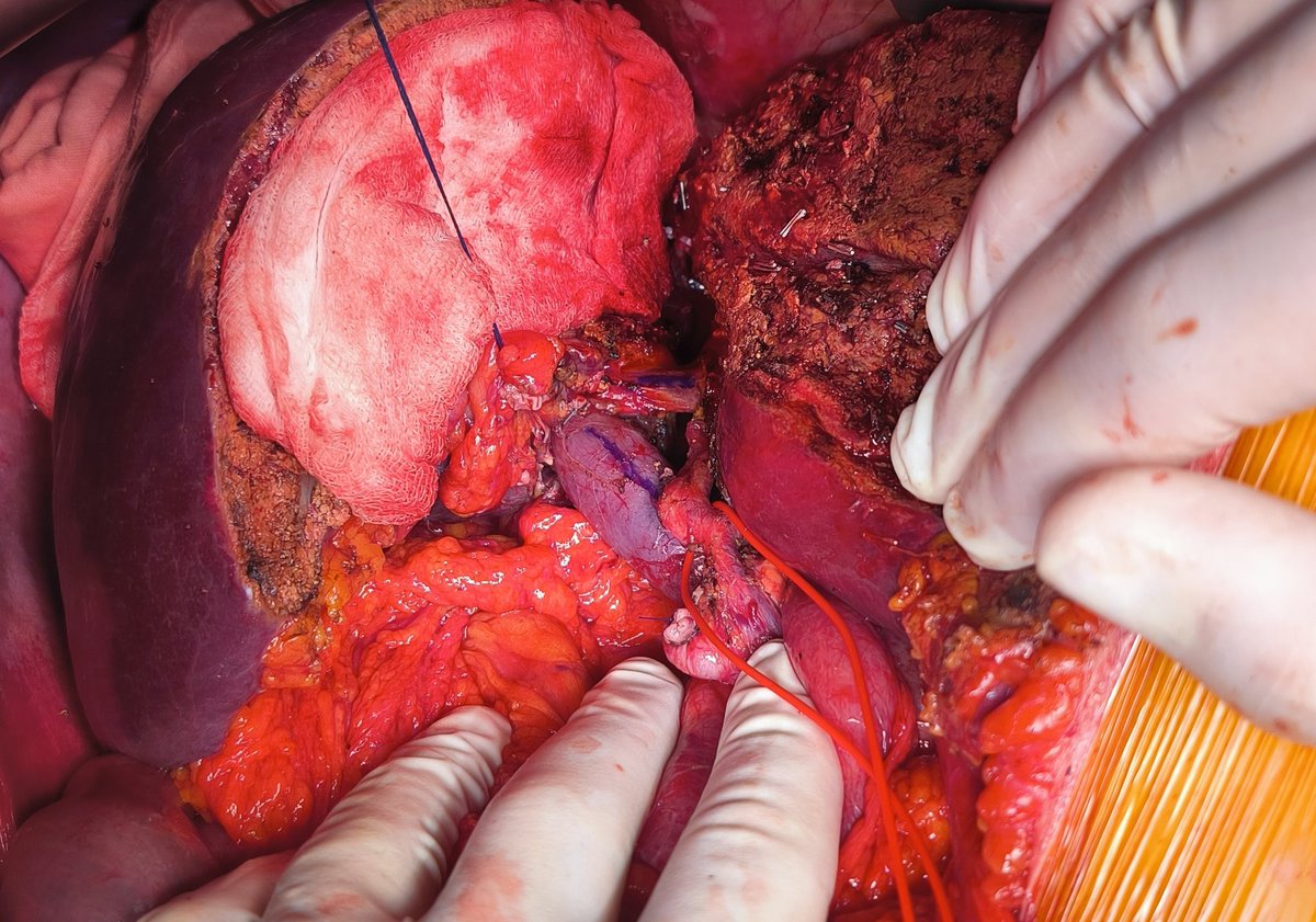 vzixus's tweet photo. The Porto-Rex shunt with external iliac vein interposition - a bailout for a failed primary portal vein reconstruction after Right hepatectomy for a hilar cholangio type  3a.
First described by Daniel Azoulay with PTFE graft: https://t.co/2V1zJIJpIt https://t.co/QqO9WDaLBv