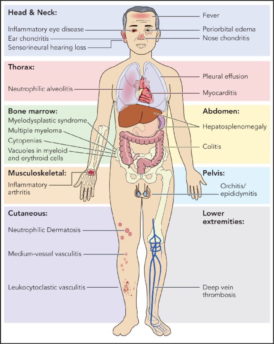 The #VEXAS expert @sinisauksav at #BSR24:

1️⃣Somatic mutations in UBA1 in myeloid cells is key finding (e.g. skin)
2️⃣Haematological manifestations are almost universal
3️⃣Long list of mimics (MDS, Sweet’s, RP)
4️⃣Interstitial lung disease can occur
5️⃣Treatment is still empirical