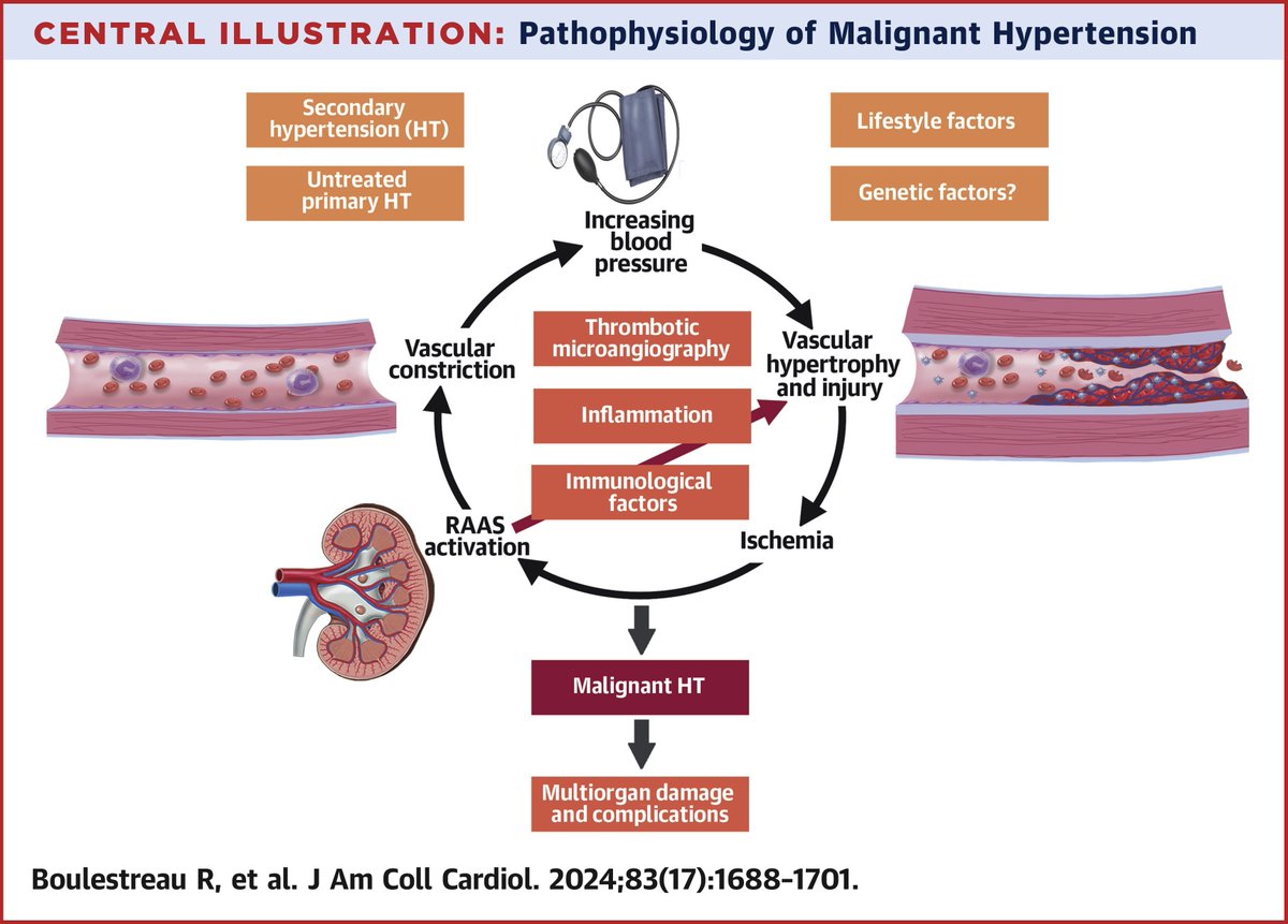 New #JACC Review Topic of the Week! Malignant #hypertension (MHT) is a growing and often overlooked issue across #medicine and #cardiology. This review discusses some of the key considerations and management decisions for patients with MHT bit.ly/3JwGzef #CardioX