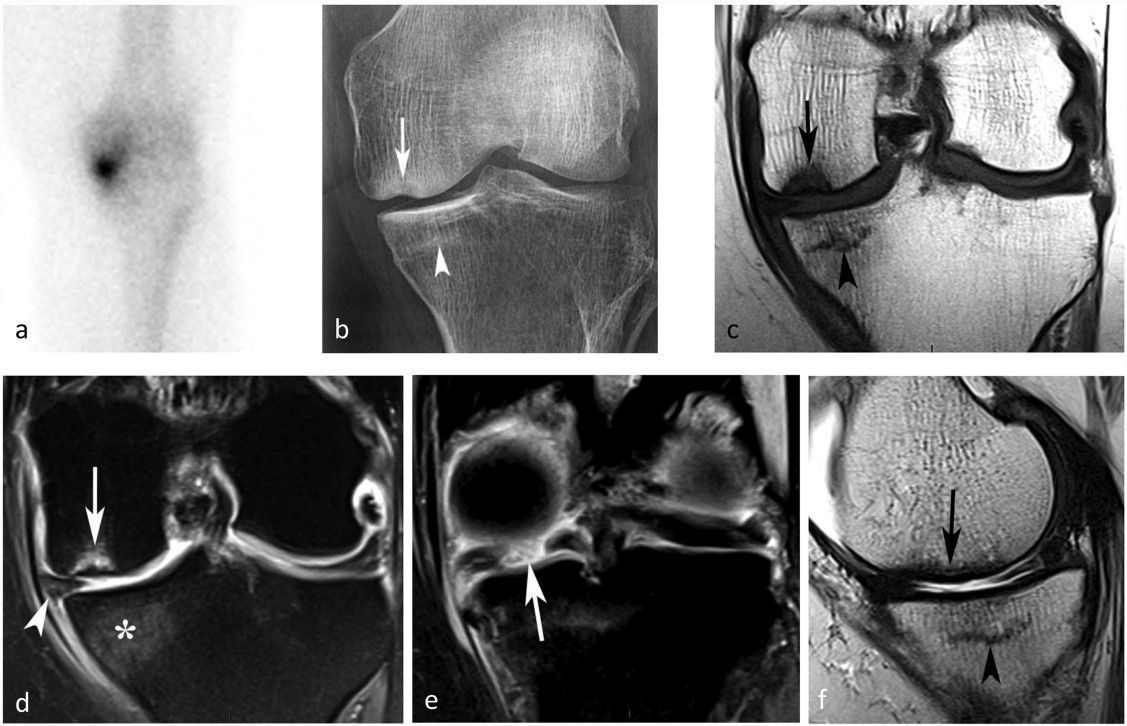 Subchondral insufficiency fractures, subchondral insufficiency fractures with osteonecrosis, and other apparently spontaneous subchondral bone lesions of the knee—pathogenesis and diagnosis at imaging. (Jacques Malghem et al.)

#InsightsIntoImaging

🔗 buff.ly/3rFDRhn