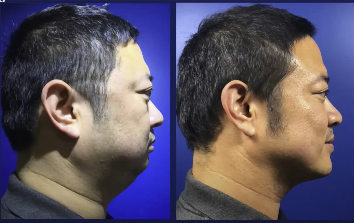 Dr Mike Mew (@orthotropics) on Twitter photo Beauty as a measure of health?
"The only way you can get
1) all the teeth to fit in the mouth
2) the tongue in the mouth (and not in the throat)
3) and an airway that doesn't collapse at night
is to create a really good looking face."
- Dr Simon Wong Beauty as a measure of health?
"The only way you can get
1) all the teeth to fit in the mouth
2) the tongue in the mouth (and not in the throat)
3) and an airway that doesn't collapse at night
is to create a really good looking face."
- Dr Simon Wong