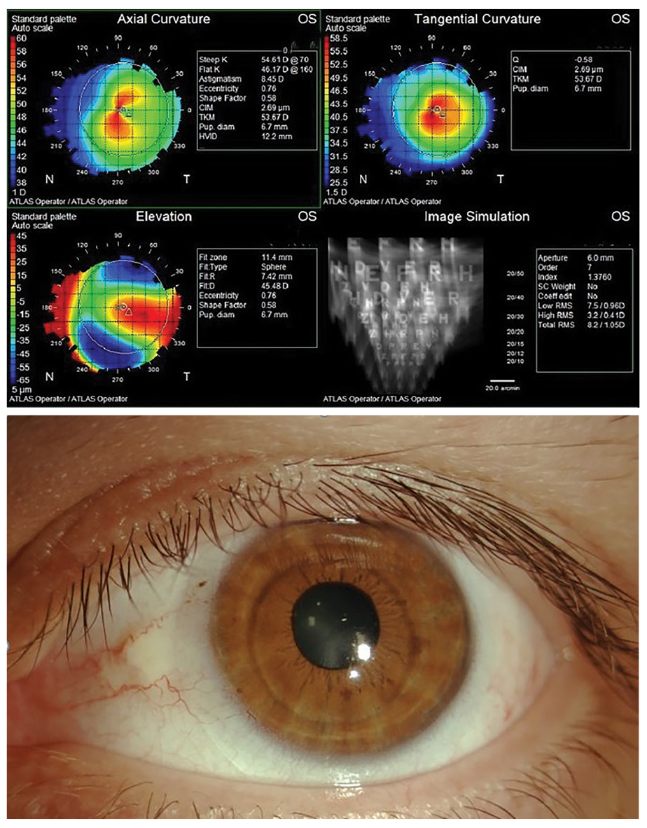 Custom vs. Standard Soft Lenses for the Irregular Cornea: How to Choose

Learn which approach works best in this case-based article by Tiffany Andrzejewski, OD, and Lindsay Sicks, OD: reviewofcontactlenses.com/article/custom…
#cornea #contactlenses #contactlens #optometry